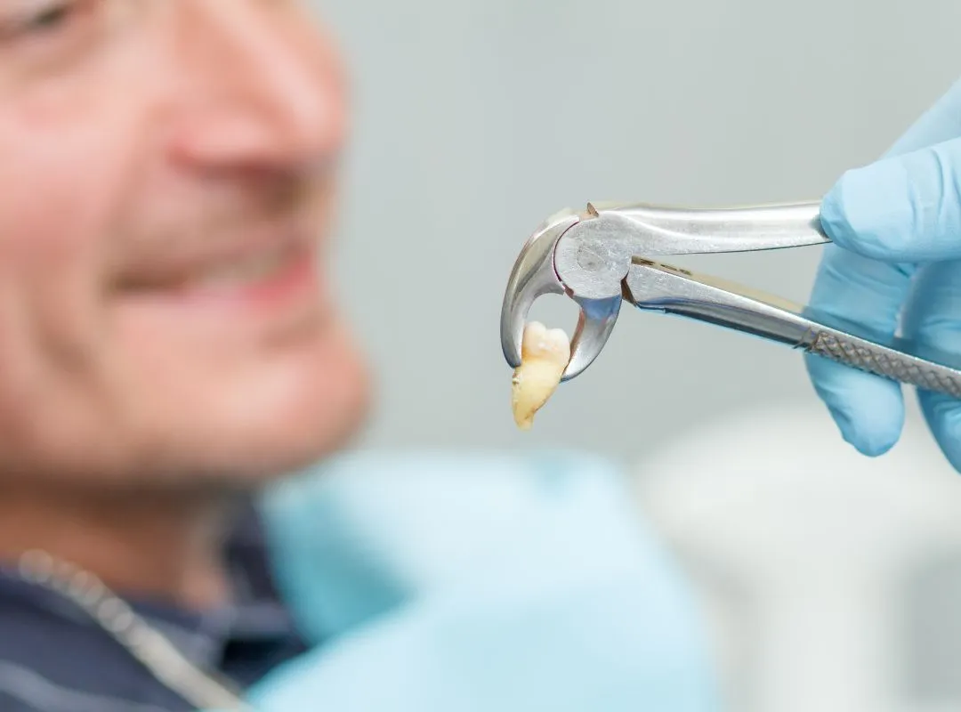 tooth extraction