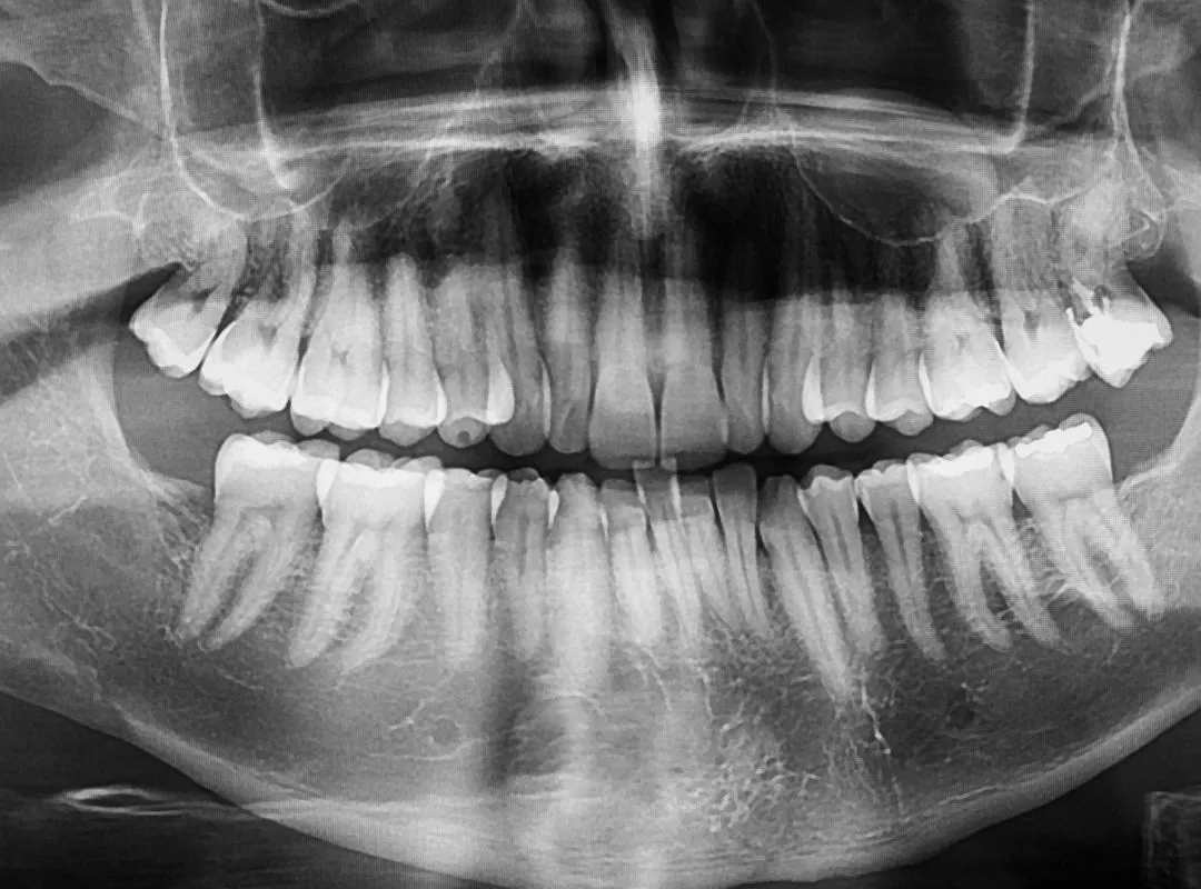 x ray