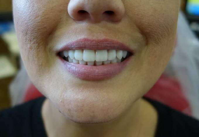 Teeth restored with dental implants