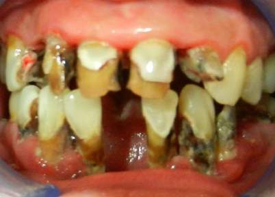 Teeth prior to treatment