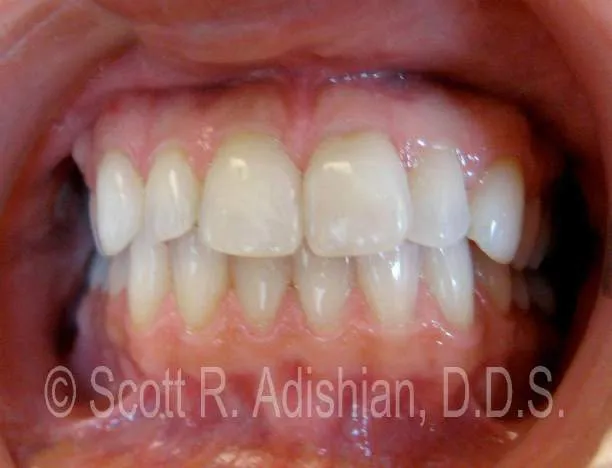 Alignment following ClearCorrect &mdash; front view