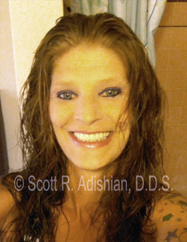 Smile following denture treatment