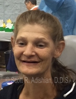 Smile prior to denture treatment