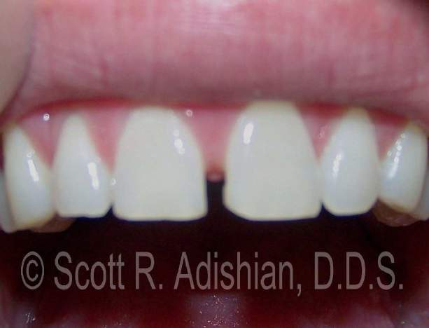 Spaces between the central teeth