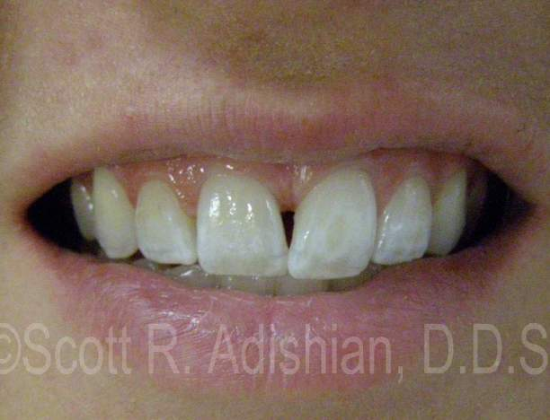 Gap between the central teeth