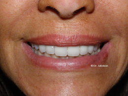 New all-ceramic crowns