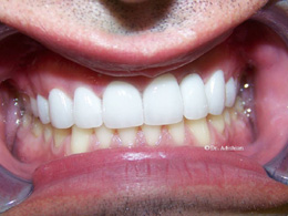 Replacement porcelain crowns