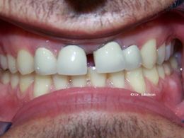 Original porcelain crowns