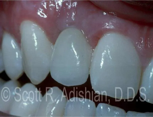 Completed implant crown