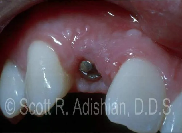 Implant in place, awaiting the crown