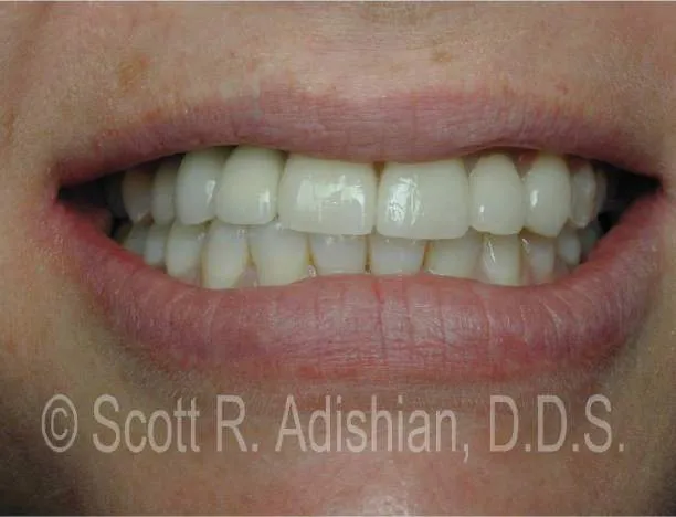 Three implant crowns joined together