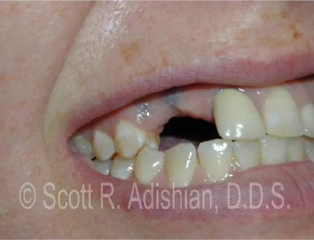 Three missing teeth