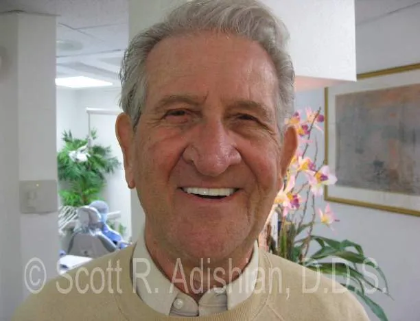 Smile following the fixed implant bridge