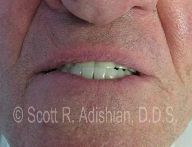 Upper denture before the fixed bridge