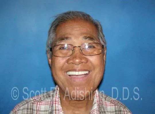 Smile following upper implant prosthesis treatment