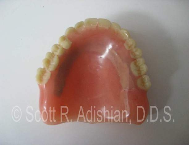 Previous denture
