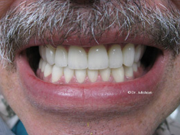 Ceramic restorations in place