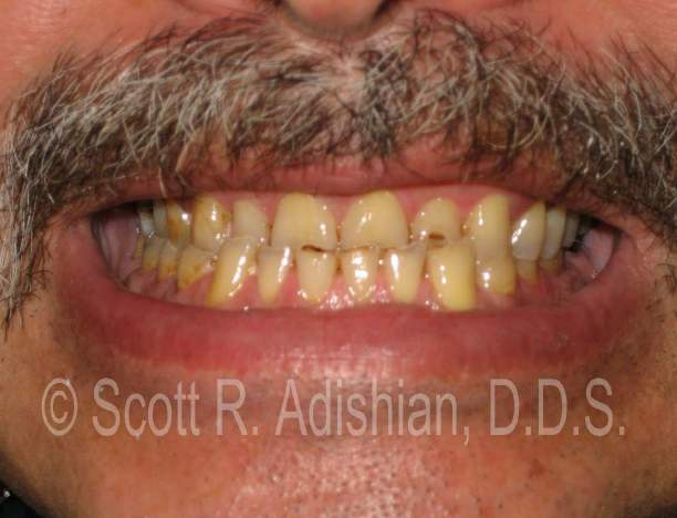 Worn and decayed teeth
