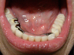 Removable partial denture in place