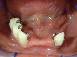 Teeth prepared for a partial denture