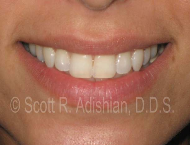 Teeth following whitening and shaping