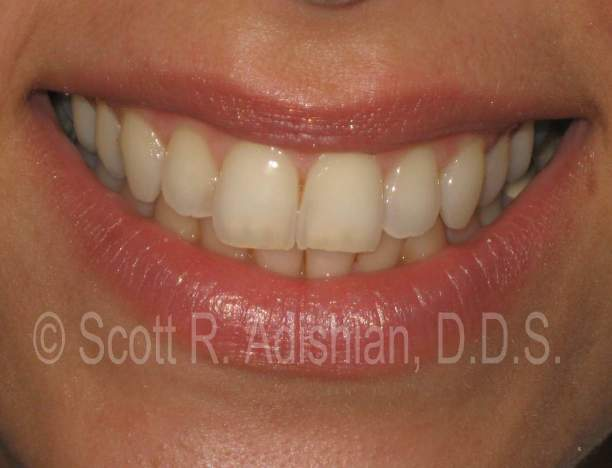 Worn tooth edges